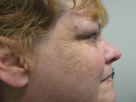 Rhinoplasty Before & After Image