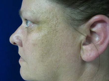 Rhinoplasty Before & After Image