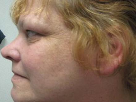 Rhinoplasty Before & After Image