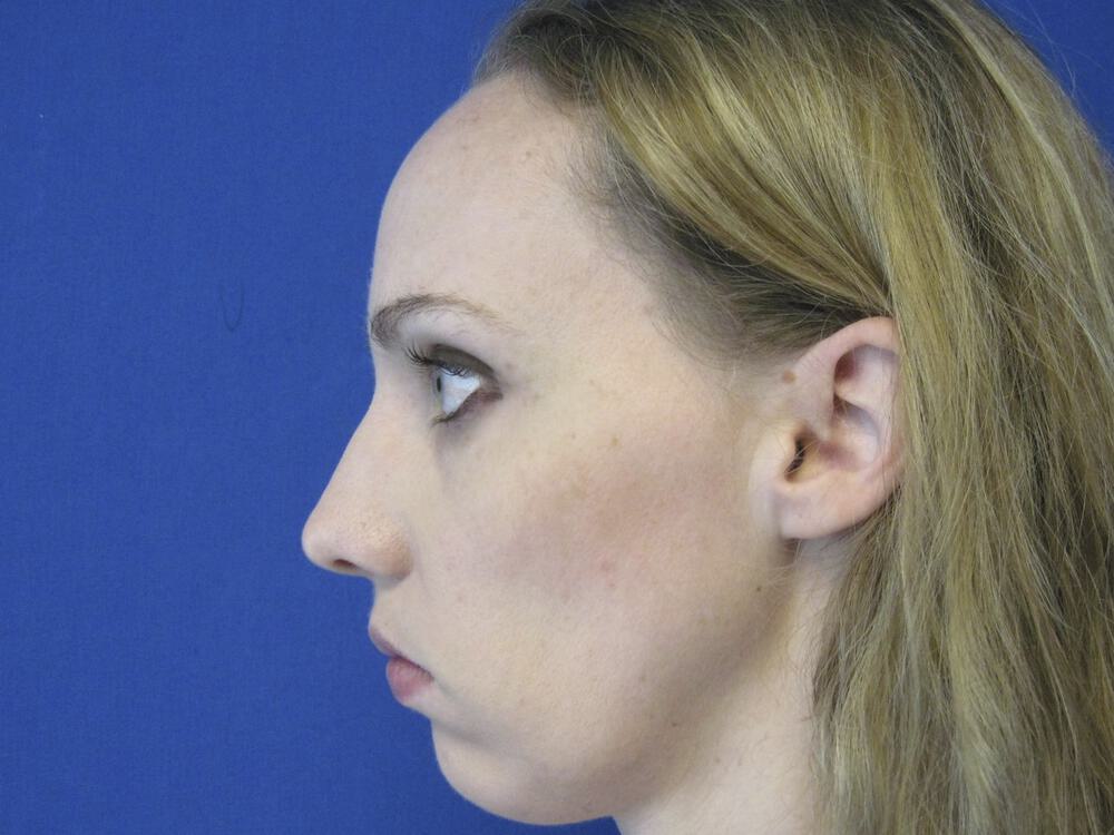 Nose reshaping women Before & After Image
