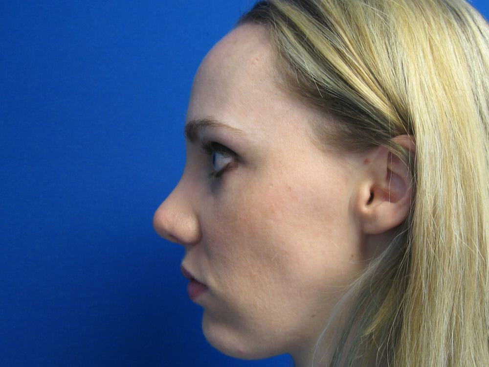 Nose reshaping women Before & After Image