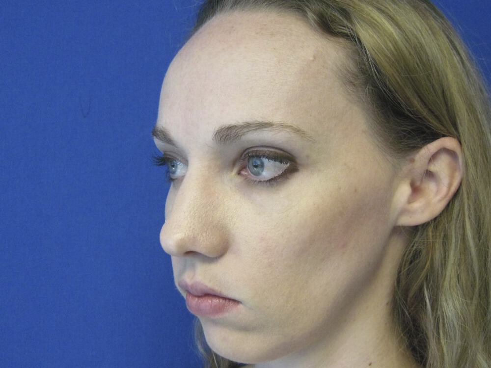 Nose reshaping women Before & After Image