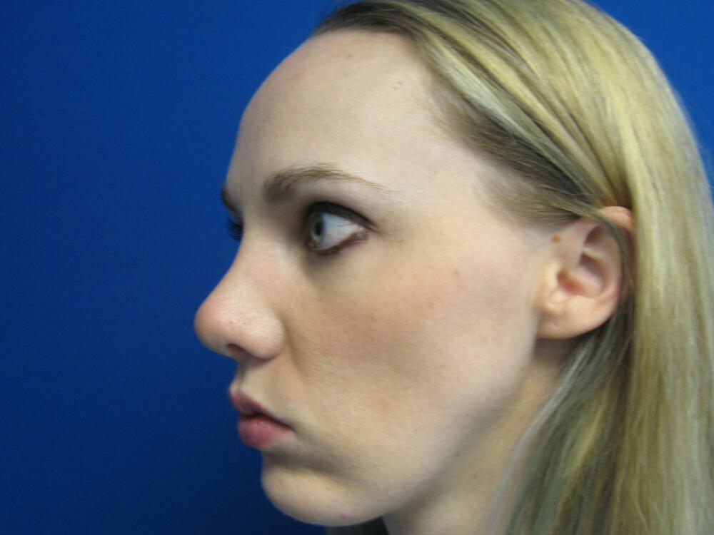 Nose reshaping women Before & After Image