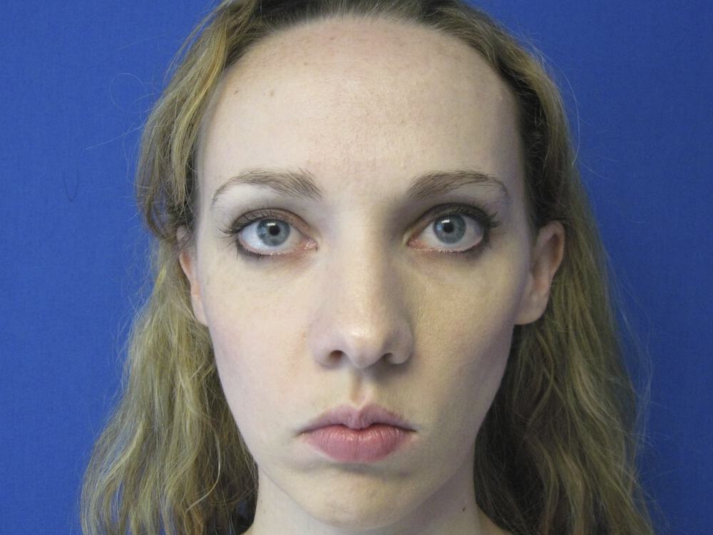 Rhinoplasty Before & After Image