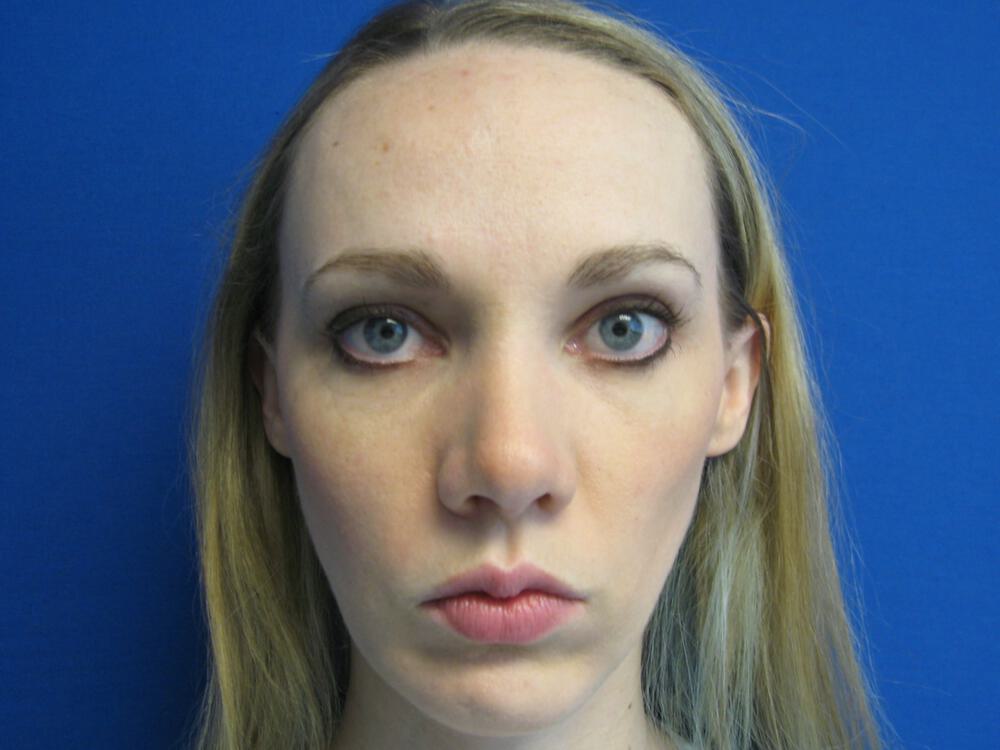 Rhinoplasty Before & After Image