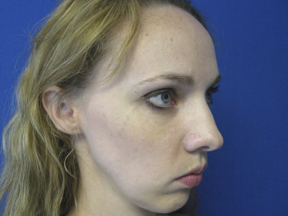 Rhinoplasty Before & After Image