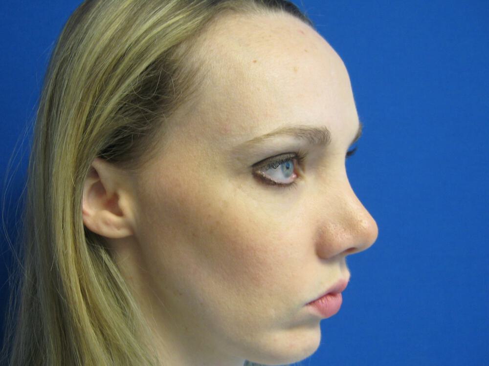 Rhinoplasty Before & After Image