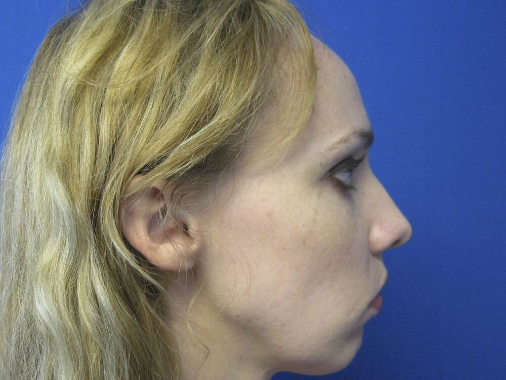 Rhinoplasty Before & After Image
