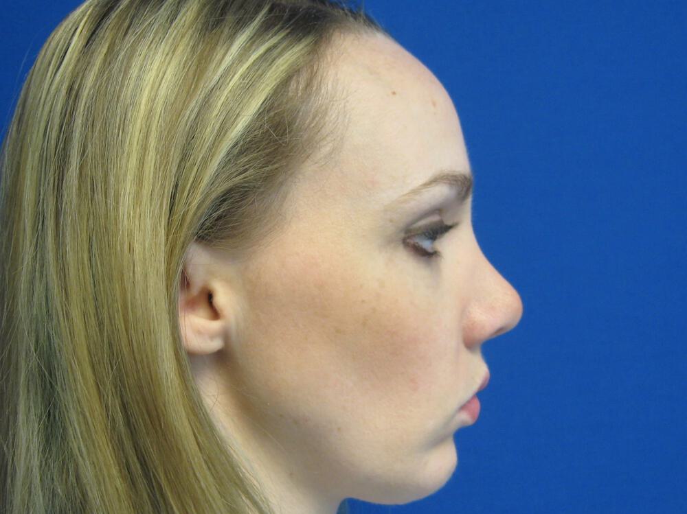 Rhinoplasty Before & After Image