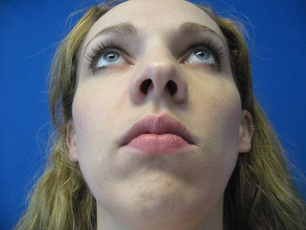 Rhinoplasty Before & After Image