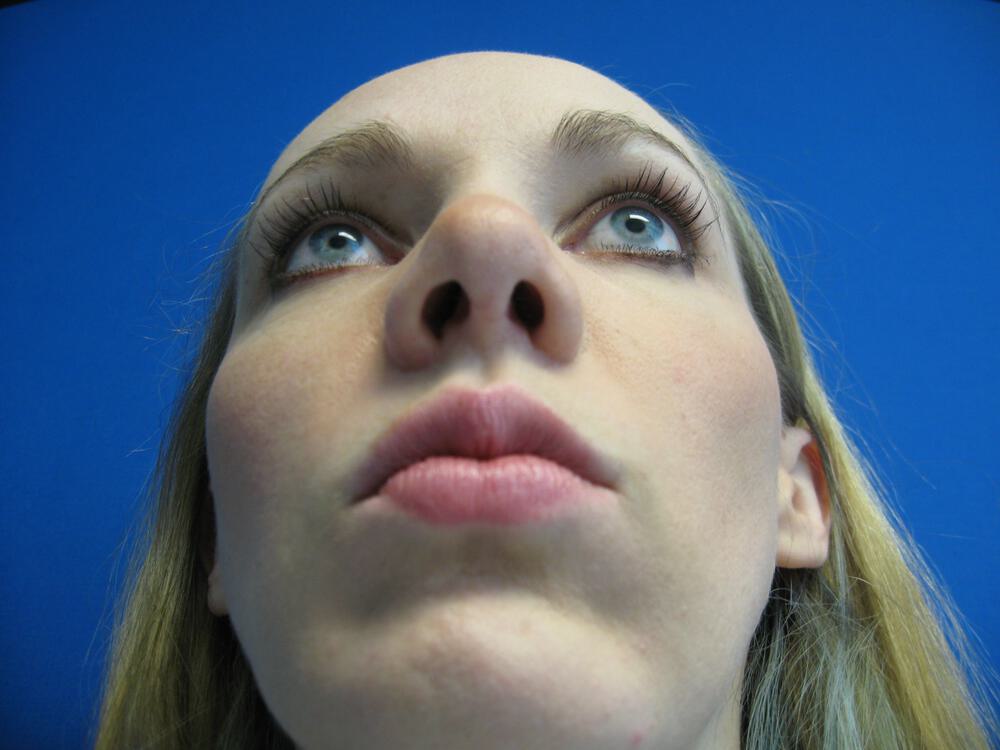 Rhinoplasty Before & After Image