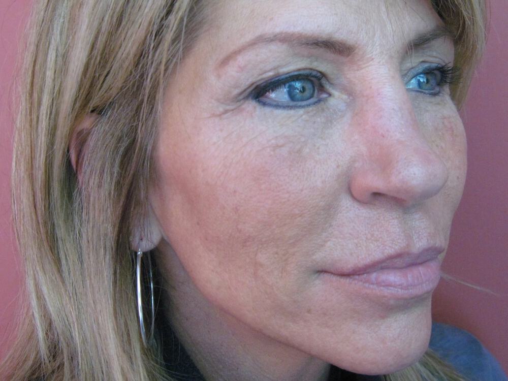 Nose reshaping women Before & After Image