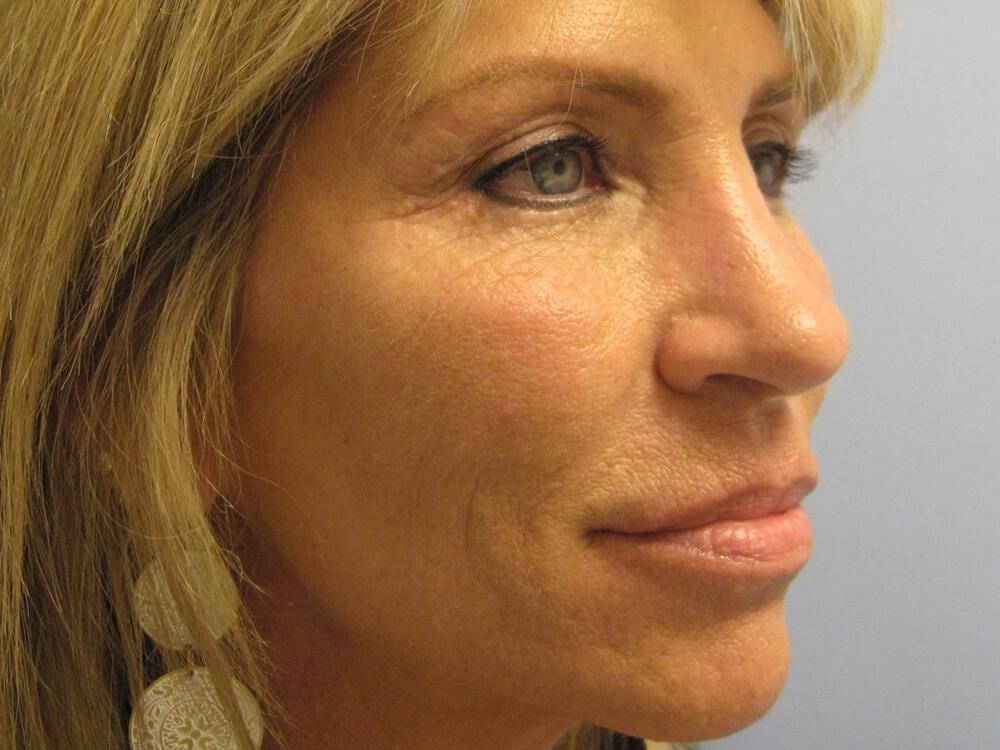 Nose reshaping women Before & After Image