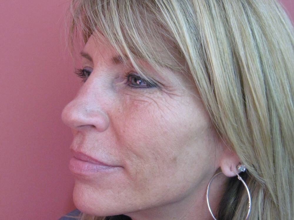 Nose reshaping women Before & After Image