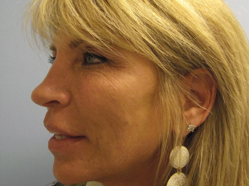 Nose reshaping women Before & After Image