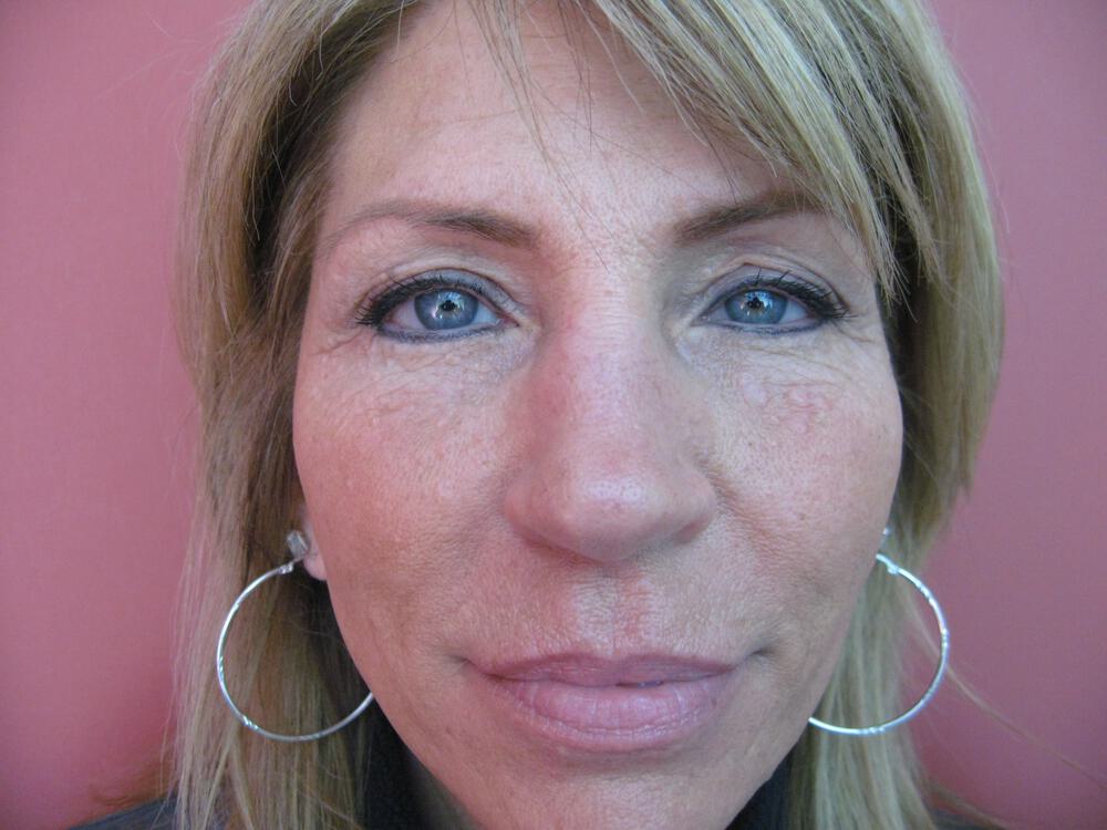 Rhinoplasty Before & After Image