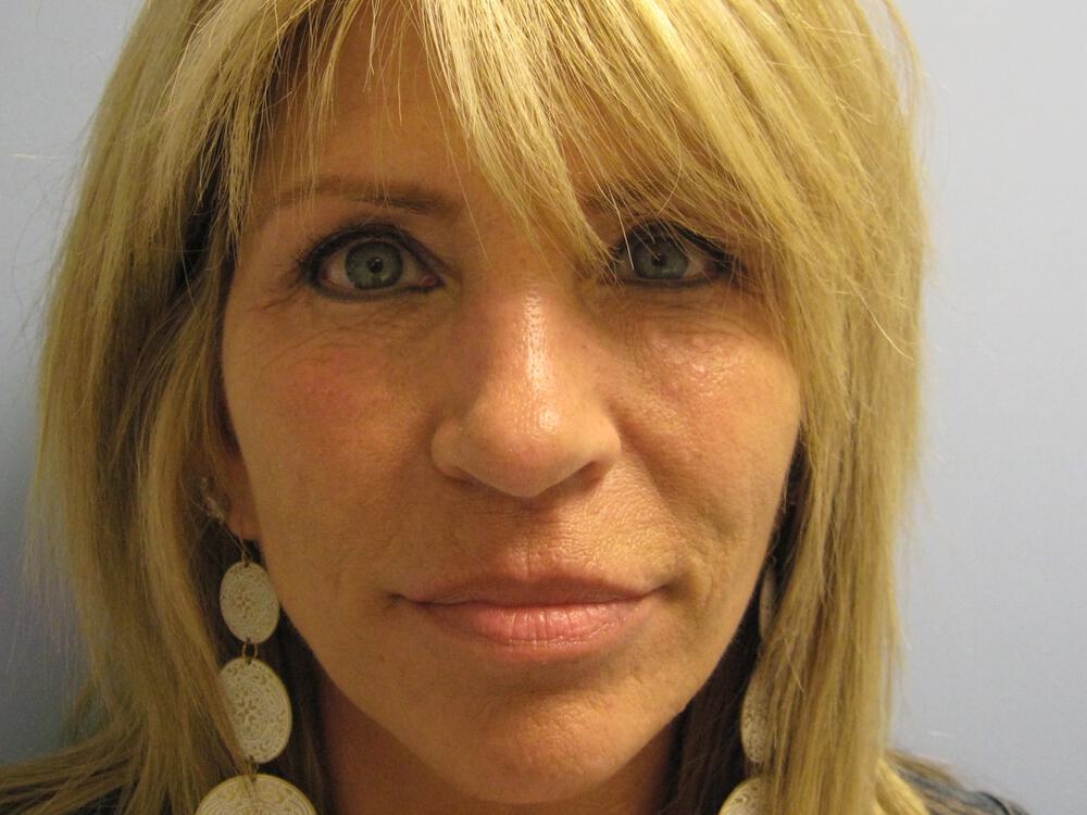 Rhinoplasty Before & After Image