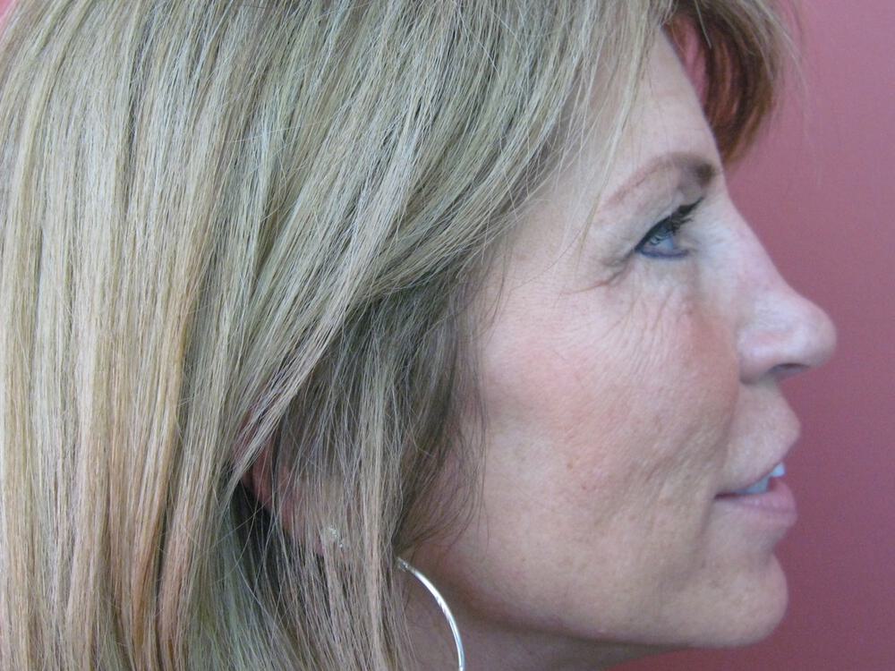 Rhinoplasty Before & After Image