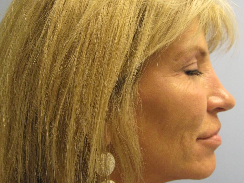 Rhinoplasty Before & After Image