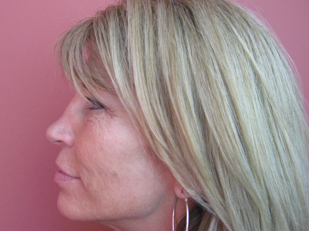 Rhinoplasty Before & After Image