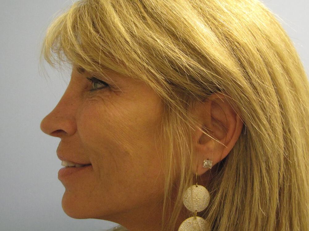 Rhinoplasty Before & After Image