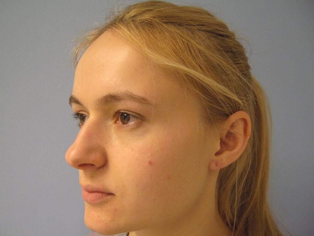 Nose reshaping women Before & After Image