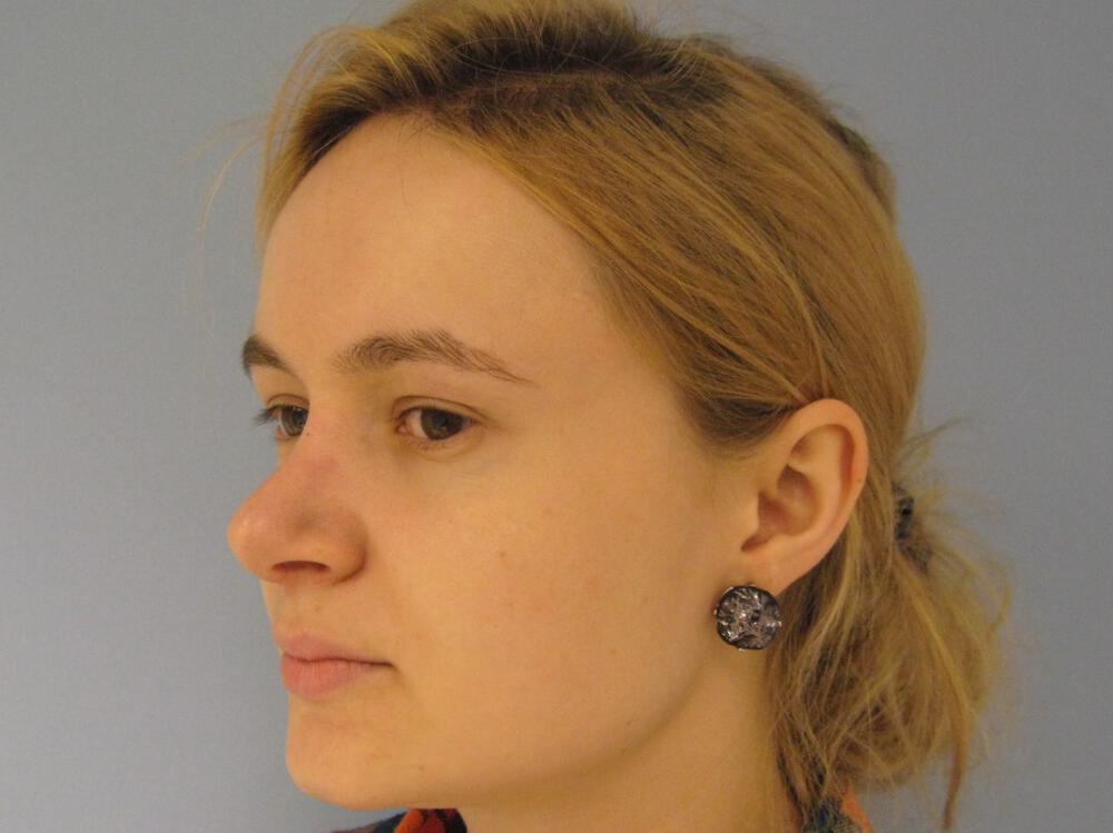 Nose reshaping women Before & After Image