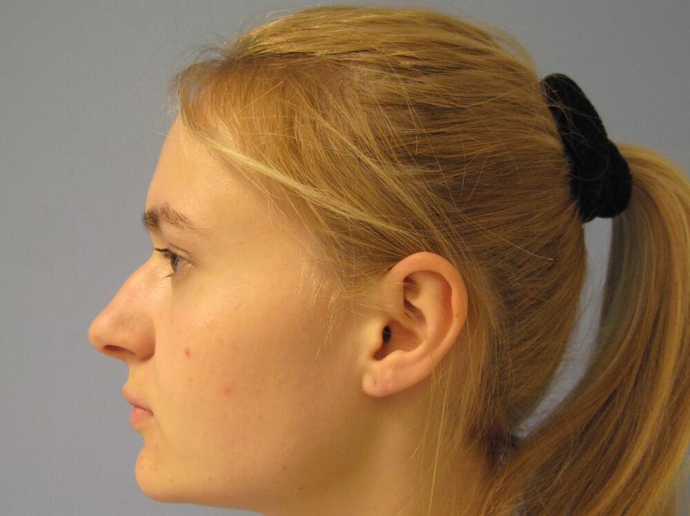 Nose reshaping women Before & After Image