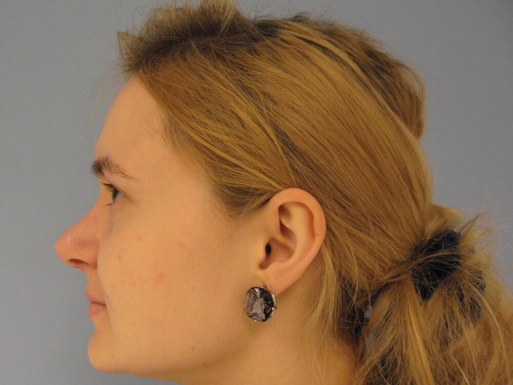 Nose reshaping women Before & After Image