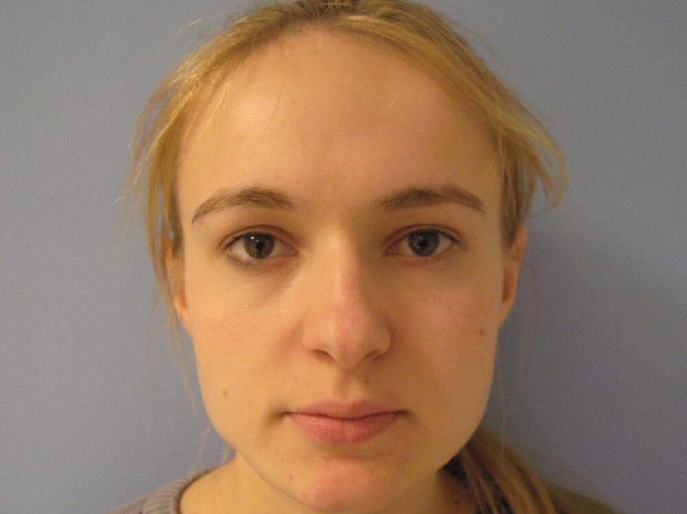 Rhinoplasty Before & After Image