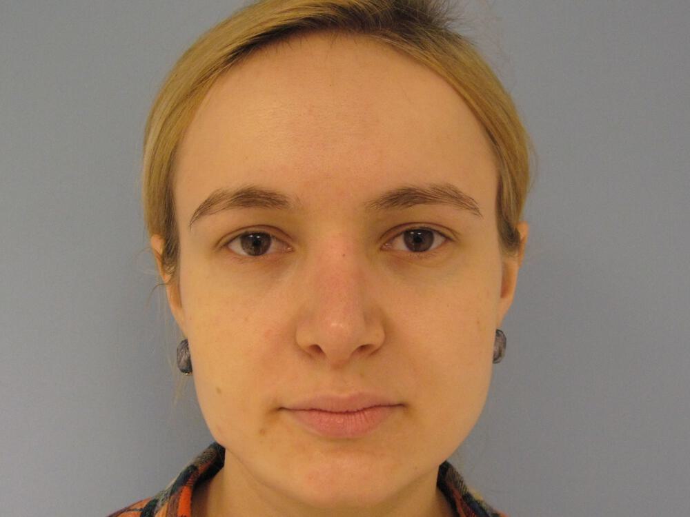 Rhinoplasty Before & After Image