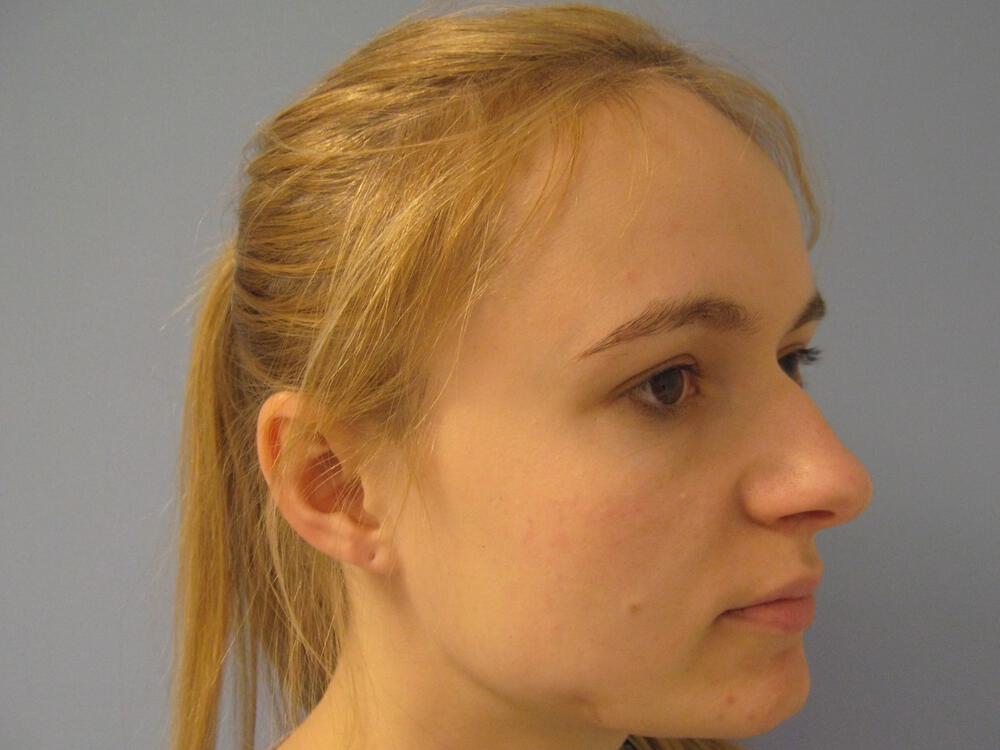 Rhinoplasty Before & After Image