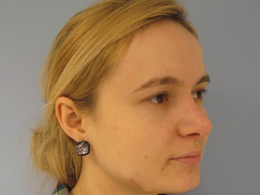 Rhinoplasty Before & After Image