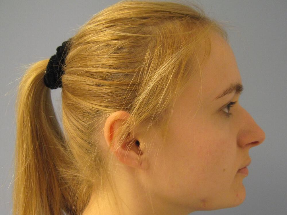 Rhinoplasty Before & After Image