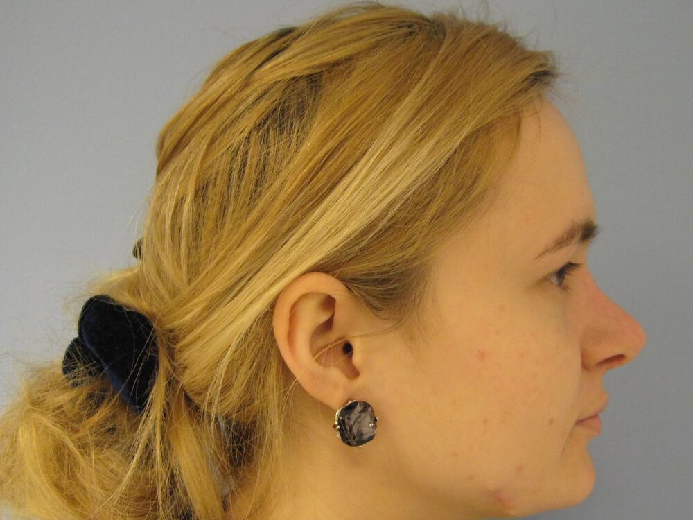 Rhinoplasty Before & After Image