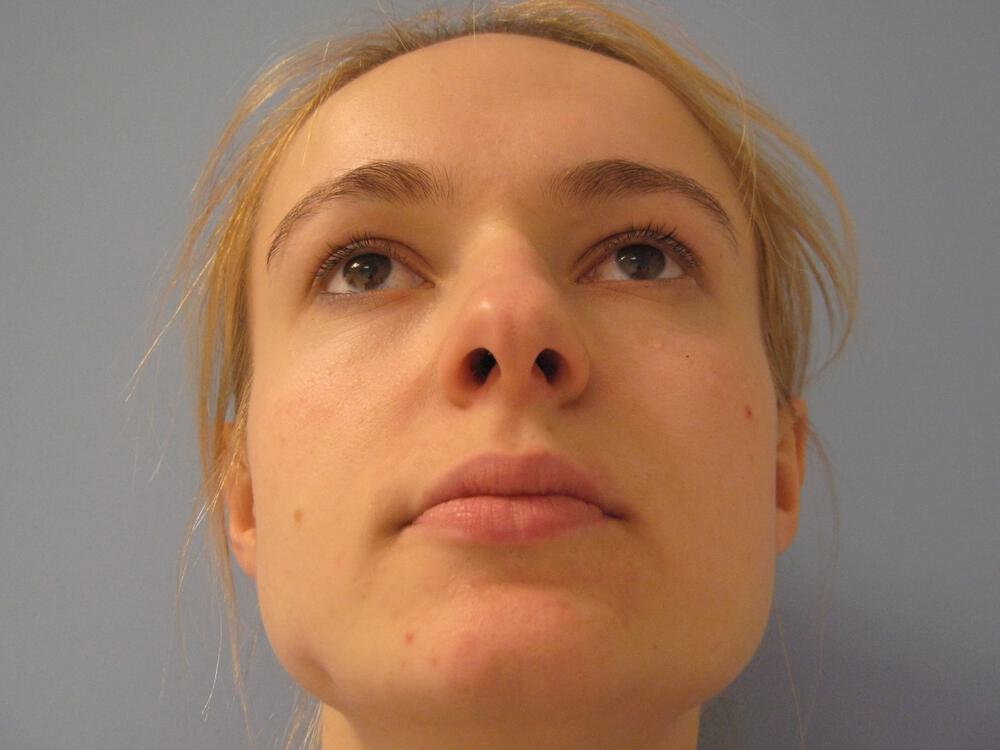Rhinoplasty Before & After Image