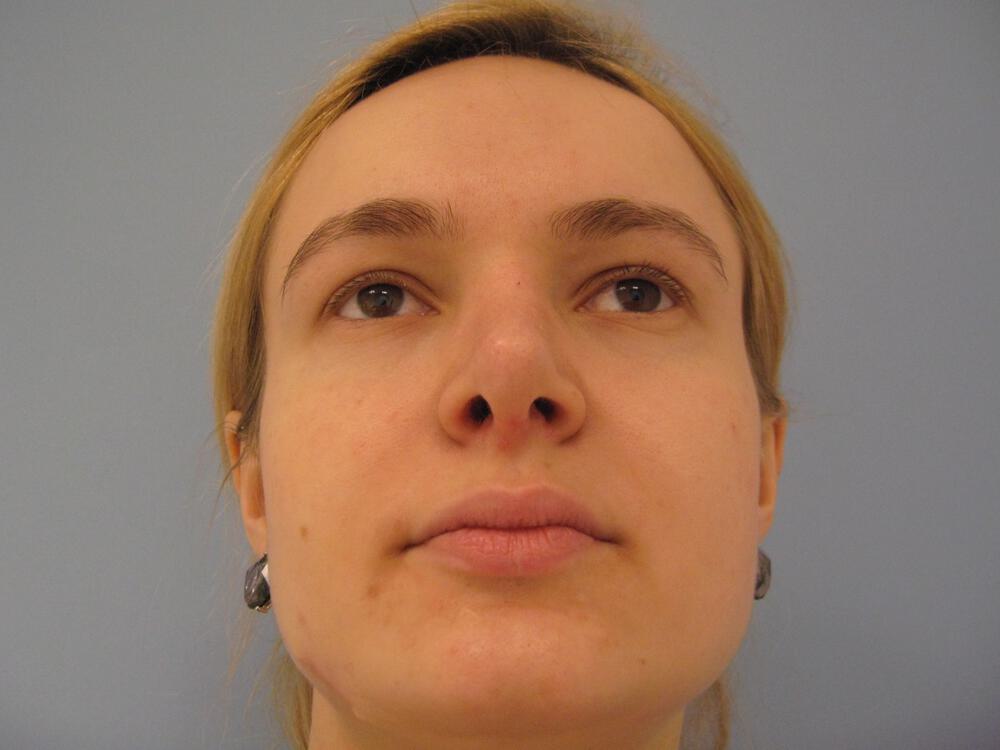 Rhinoplasty Before & After Image