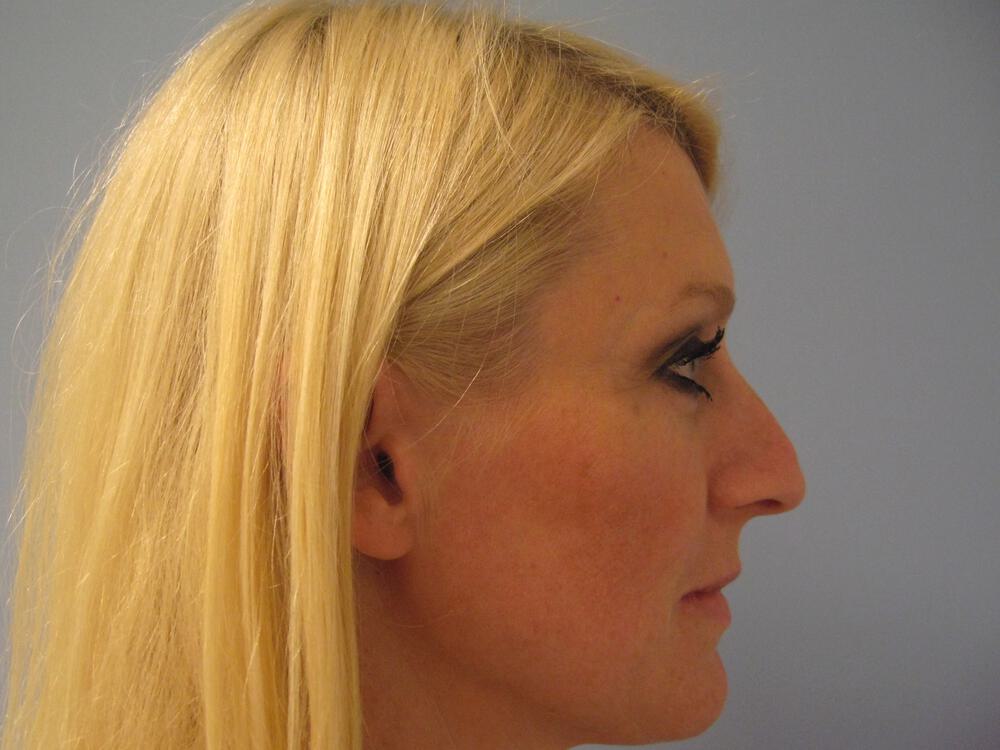 Nose reshaping women Before & After Image