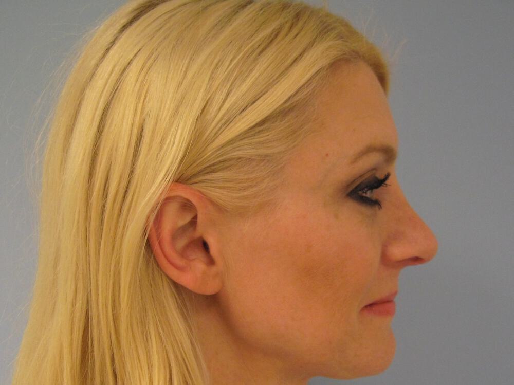 Nose reshaping women Before & After Image