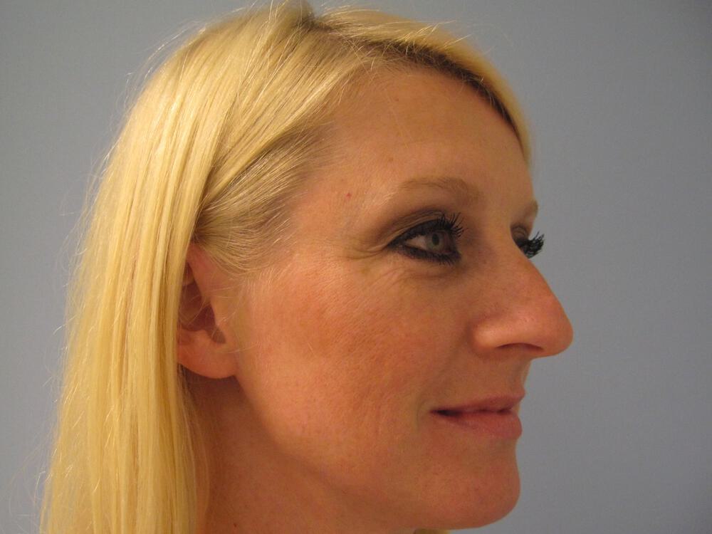 Nose reshaping women Before & After Image