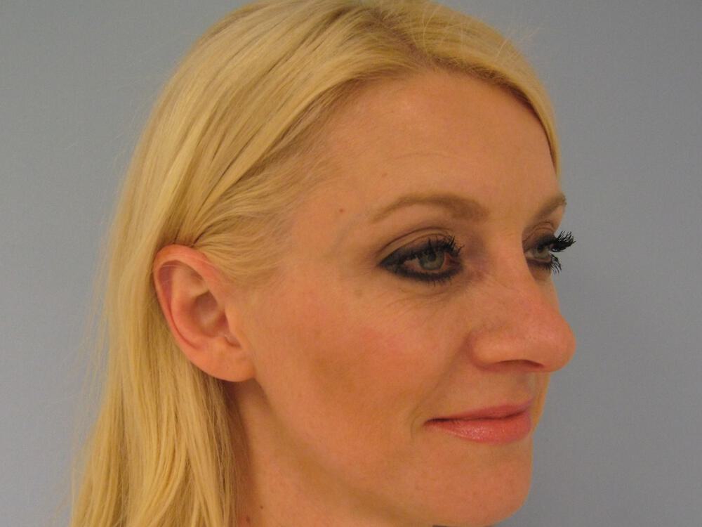 Nose reshaping women Before & After Image