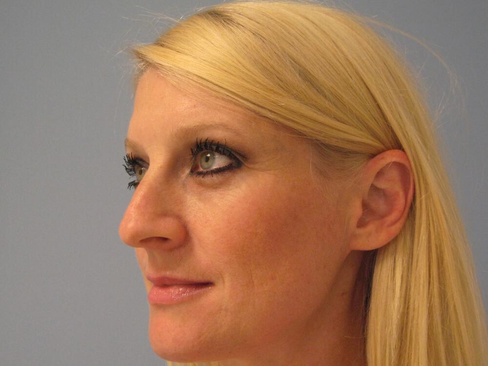 Rhinoplasty Before & After Image