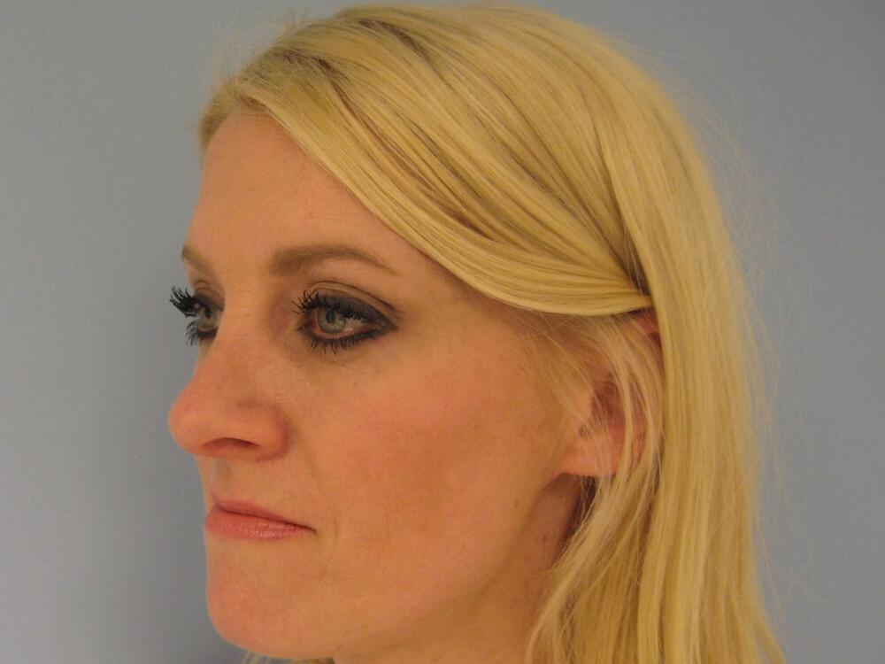 Rhinoplasty Before & After Image