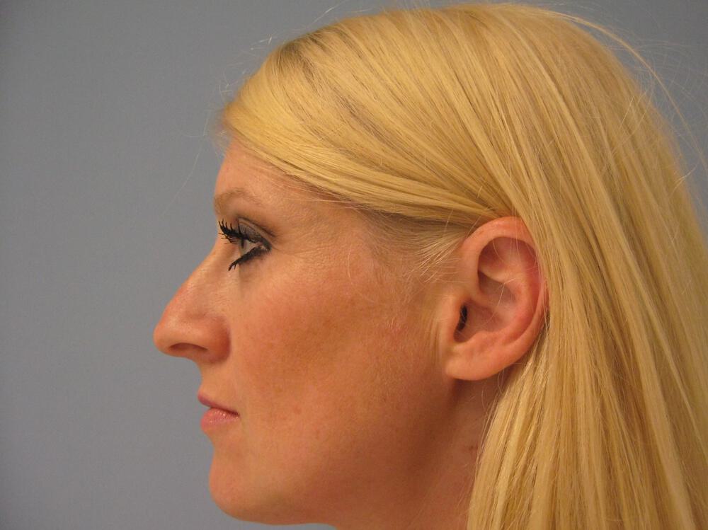 Rhinoplasty Before & After Image