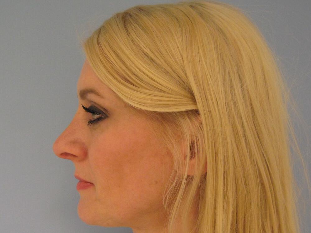 Rhinoplasty Before & After Image