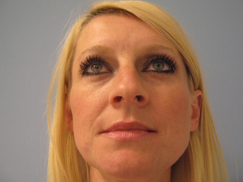 Rhinoplasty Before & After Image