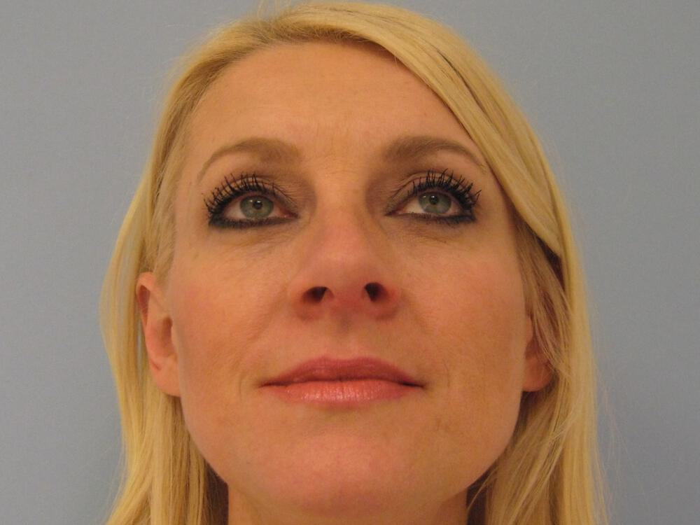 Rhinoplasty Before & After Image