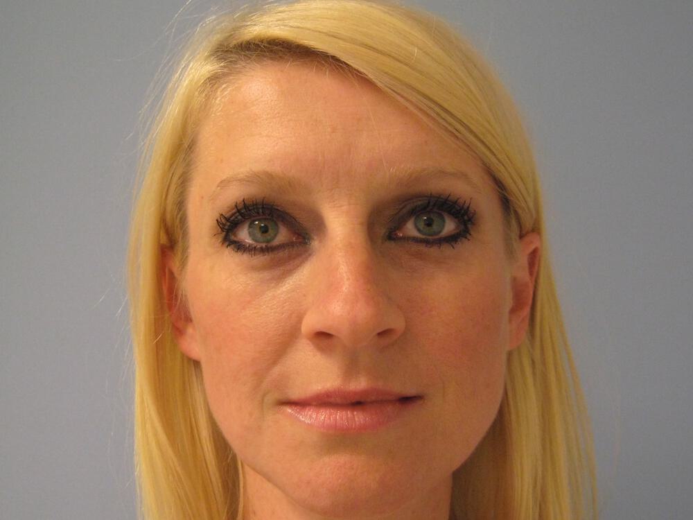 Rhinoplasty Before & After Image