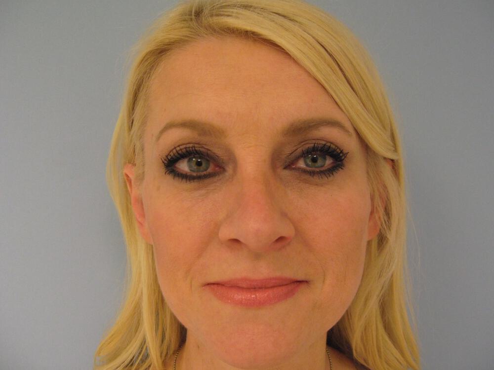 Rhinoplasty Before & After Image