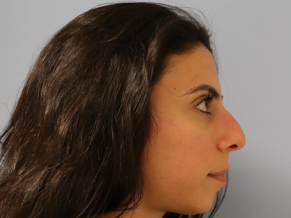 Nose reshaping women Before & After Image